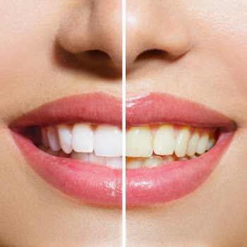 Teeth Whitening by Elegant Image